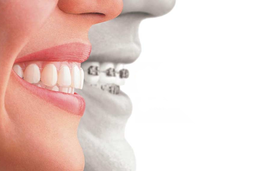 difference between braces and Invisalign