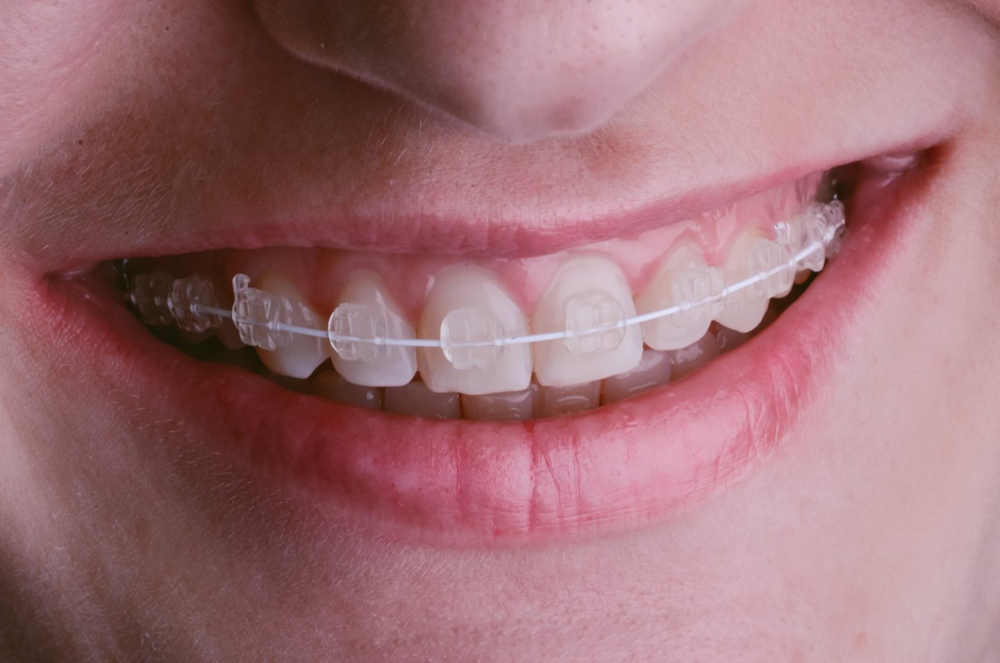 What to Expect During the Process of Getting Braces
